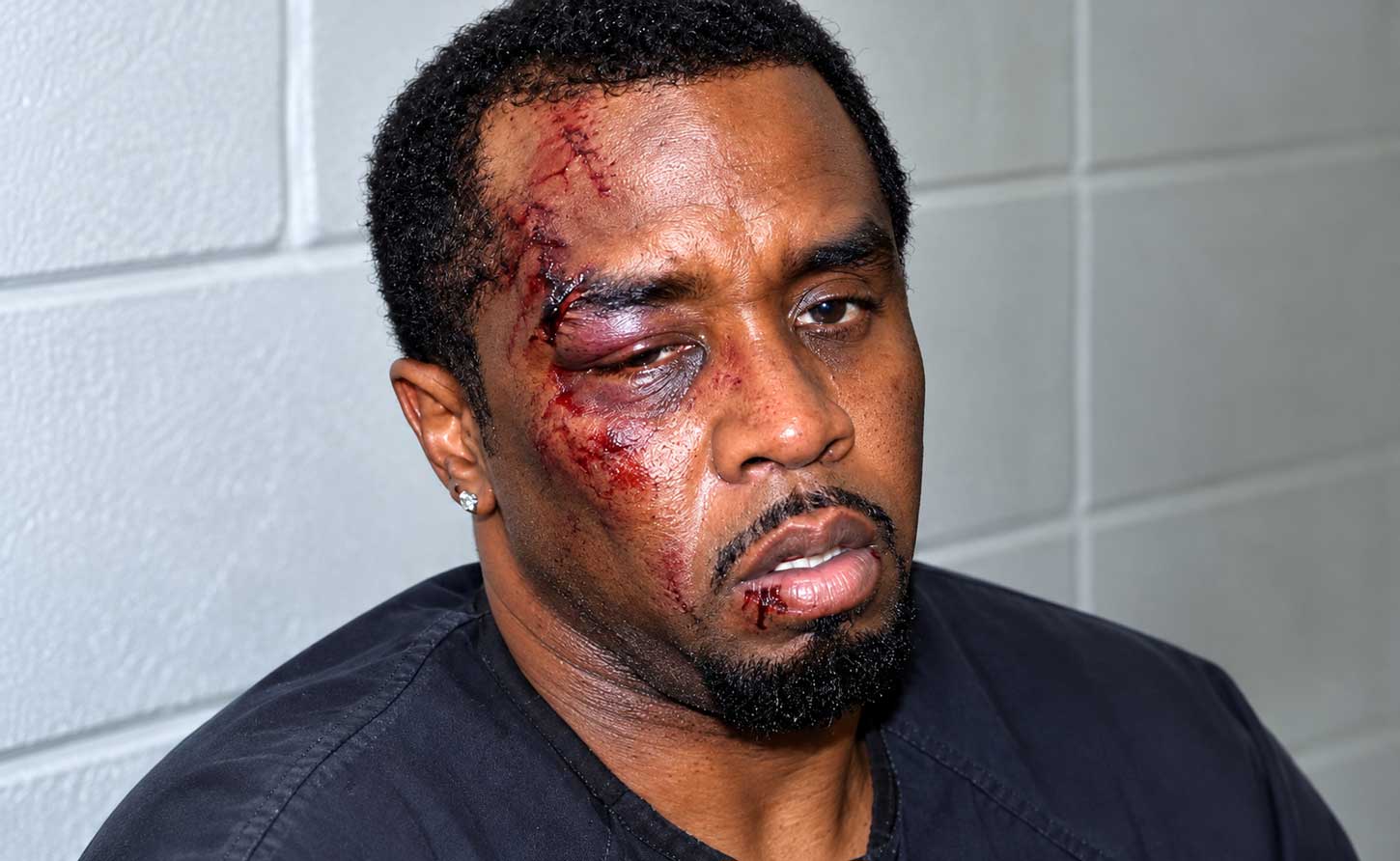 Sean “Diddy” Combs with an head injury after the altercation with Dudus Coke at the Fort Dix New Jersey Prison.